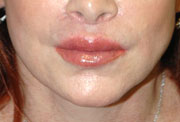 Revision Lip Augmentation - Patient 1 - After
